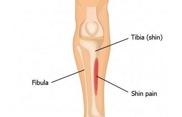 shin splints treatment perth