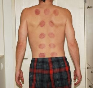 Cupping