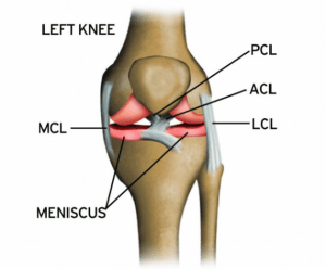 ACL Injury of the knee. Anterior cruciate ligament injury.