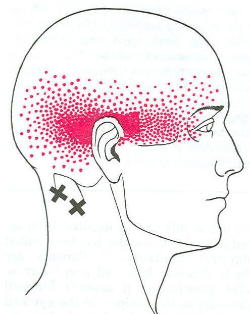 Headaches – Self Treatment and Physio