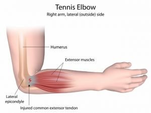 tennis elbow perth physio