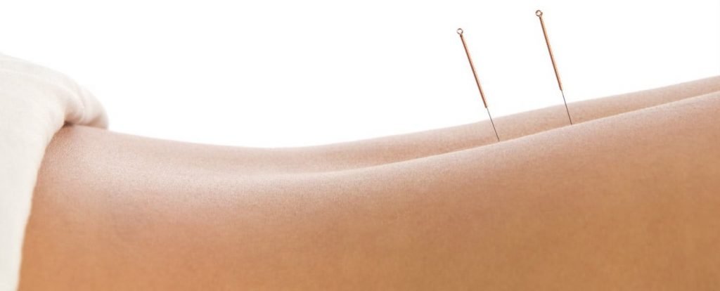 dry needling acupuncture Perth
