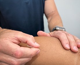 Person receiving dry needling in sorrento