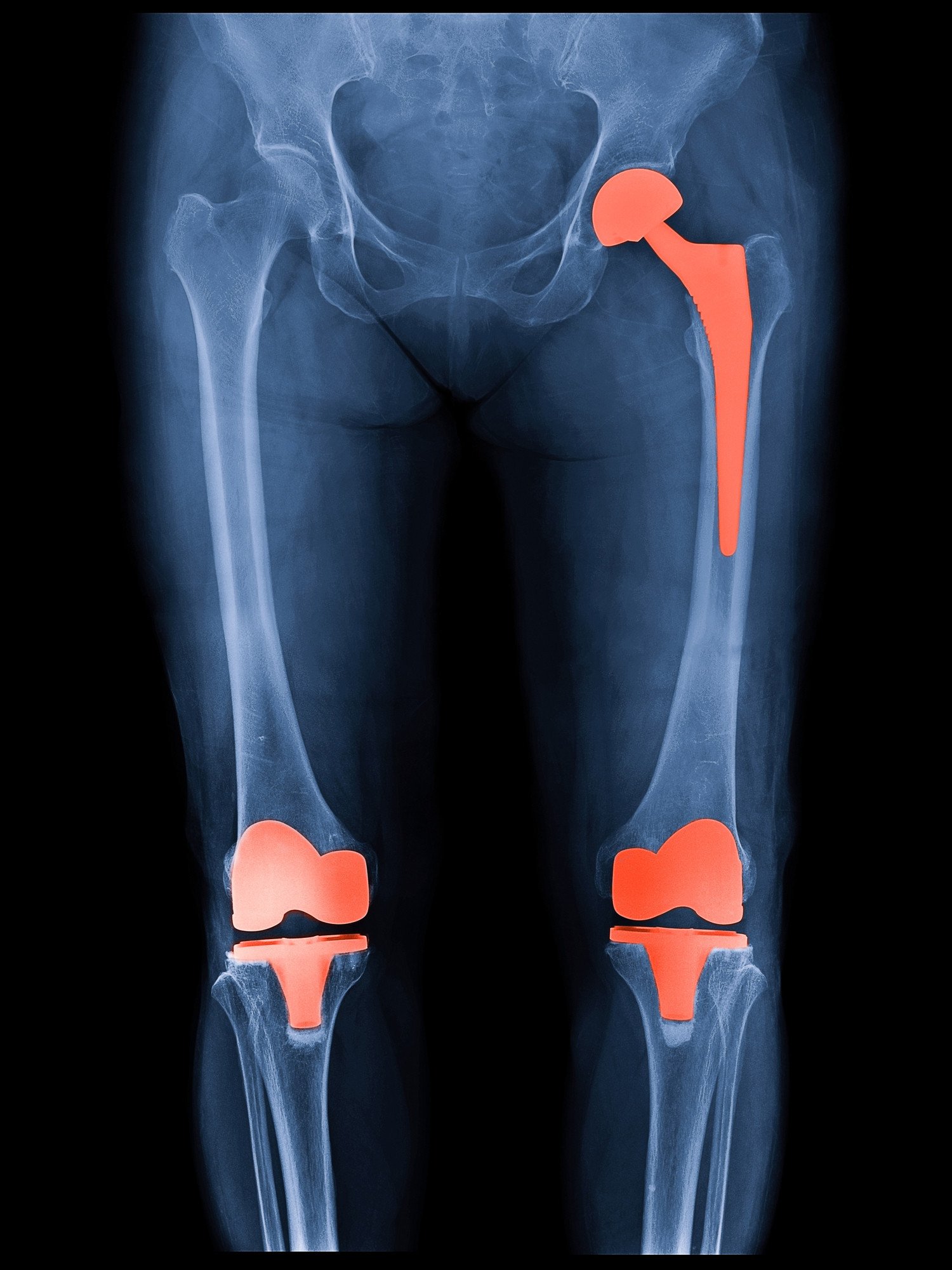 Is It Time to Consider Joint Replacement Surgery? A Physio’s Guide